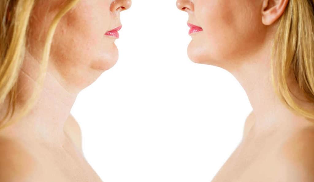 Double Chin treatment Shirley before and after results