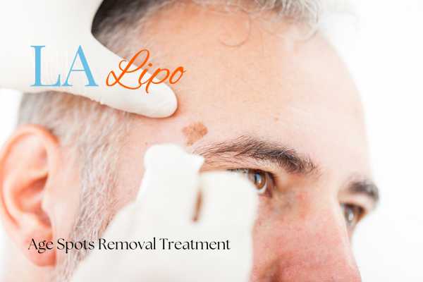 What Are the Most Effective Treatments for Age Spots Shirley?