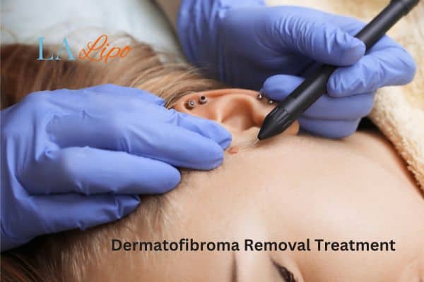Dermatofibroma Removal Treatment Shirley