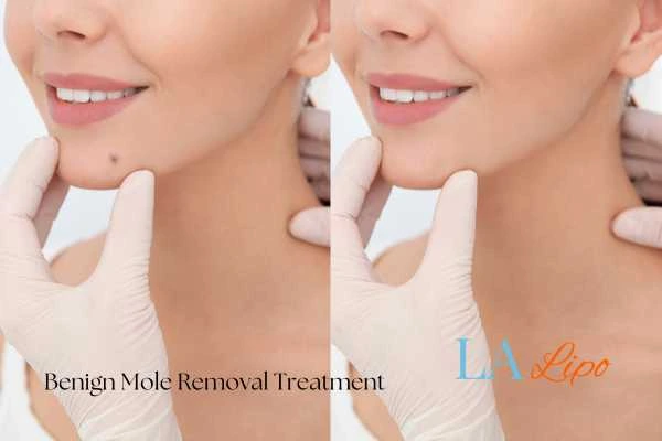 woman's before and after mole removal Shirley results