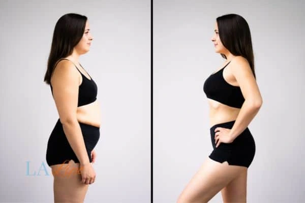 image of woman before and after results of LA-EMS Body Sculpting Shirley to help treat Diastasis recti