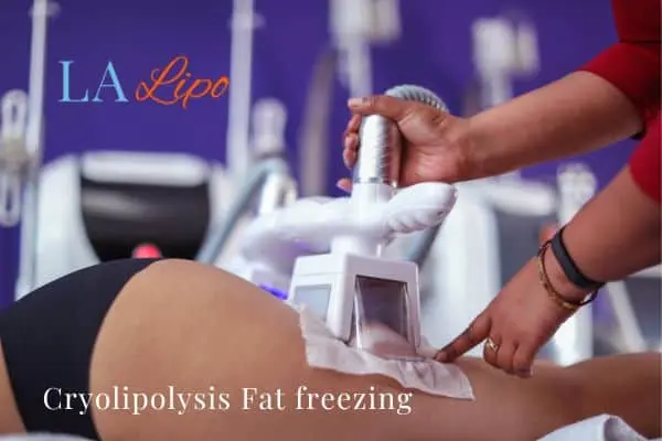 women getting fat freezing Shirley