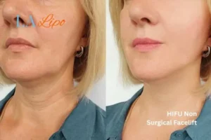 hi-fu for wrinkles Shirley before and after results