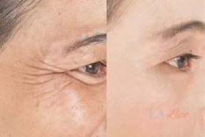 Before and after results of woman - HI-fu wrinkles reduction treatment Shirley