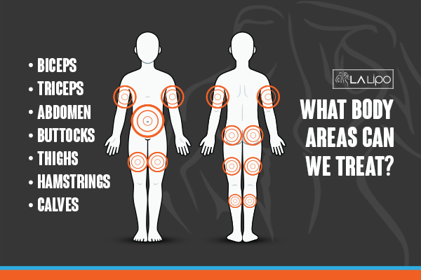 Graphic to show areas you can have LA-EMS Body Sculpting Shirley treatment.