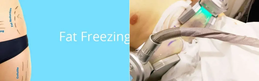 Fat freezing Shirley on multiple areas of the body