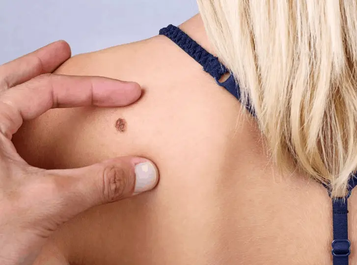 woman having mole removal Shirley consultation before treatment.