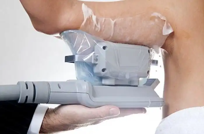 Picture of fat freezing Shirley on the upper arms.