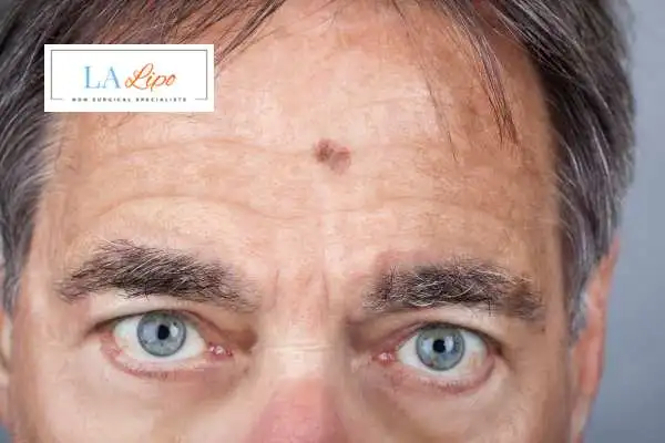 Solar Lentigo Removal Shirley image of man with mark on his forehead