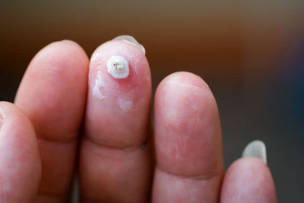 wart on person finger - cryotherapy to treat from LA LIPO Shirley