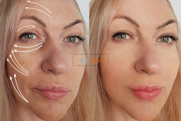 Morpheus 8 results Shirley face lift.