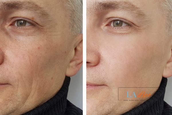See the amazing results of Morpheus8 Treatment Shirley!