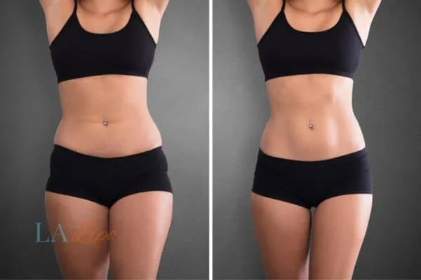 before and after results of non-surgical treatment to help a woman's body image and mental health Shirley