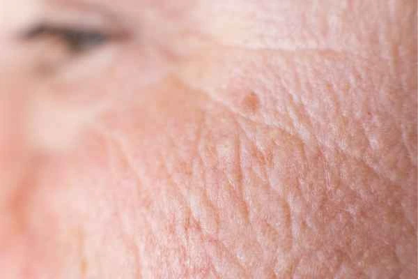 close up picture of a woman's face showing an age spot Shirley