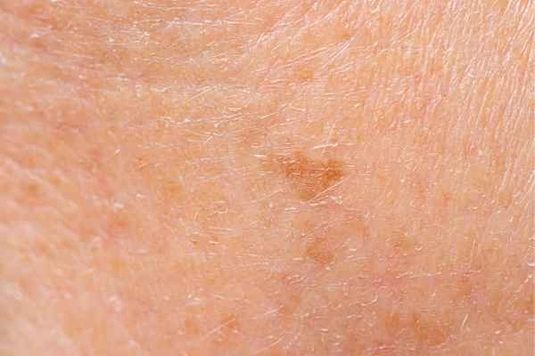close up picture of age spots Shirley