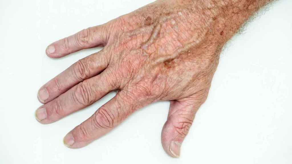 Male hand showing age spot Shirley