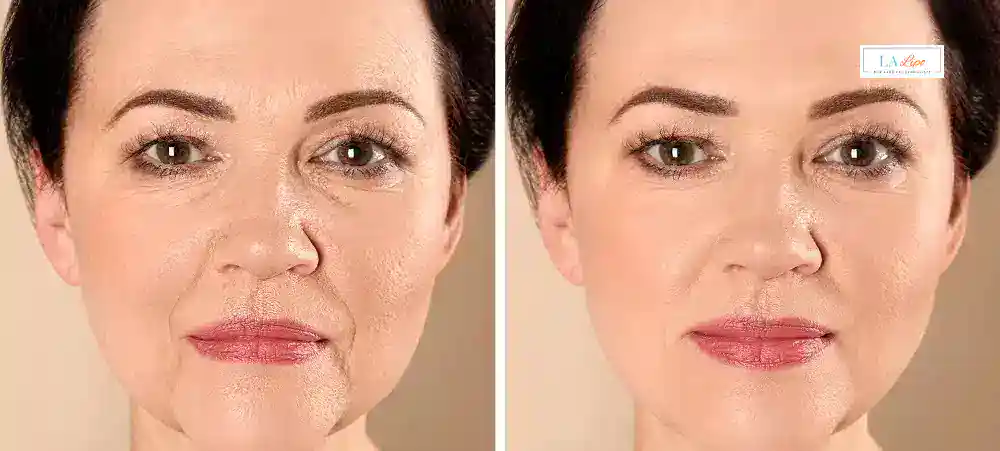 How Long Does It Take to See Results and How Long Do They Last Shirley?