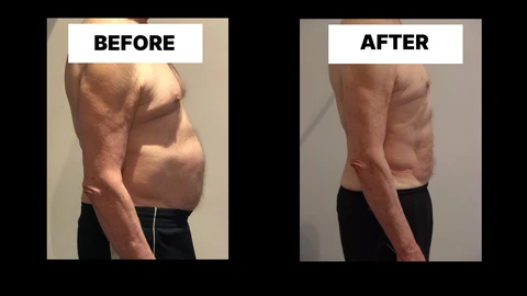 What Symptoms Can Diastasis Recti Cause in Men? Weak Core, Back Pain and Poor Posture Shirley